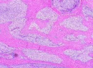 子宫内膜间质肉瘤