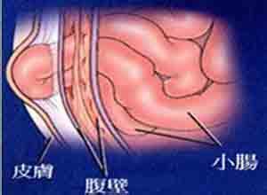 妊娠合并肠梗阻