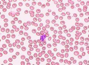 小儿遗传性椭圆形红细胞增多症
