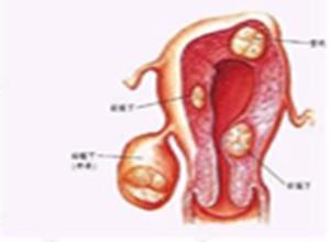 子宫颈平滑肌瘤