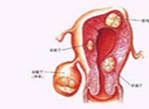 子宫平滑肌肉瘤