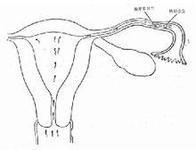 输卵管狭窄