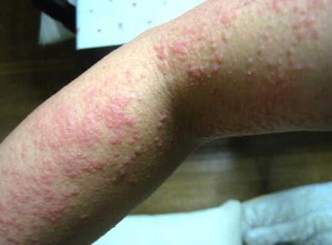 痱子和湿疹的区别8不同